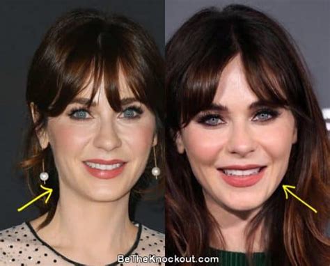 zooey deschanel facelift|Zooey Deschanel Botox And Plastic Surgery